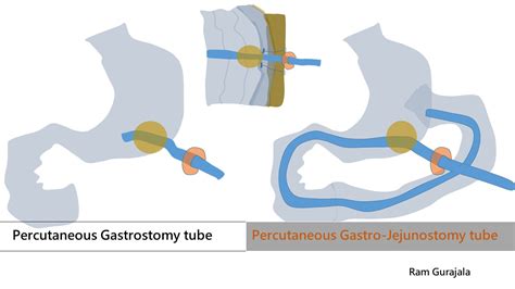 Percutaneous Gastrostomy/Gastro-Jejunostomy tube placement | IR 4 U