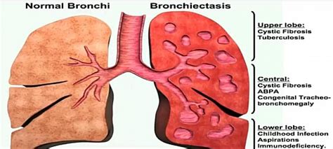 Bronchiectasis Symptoms, Causes, Diagnosis, Treatment, Prognosis and ...