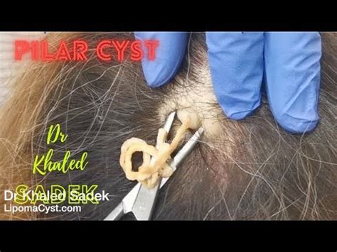 Pilar Cyst Removal. London.Dr Khaled Sadek. LipomaCyst.com - YouTube ...