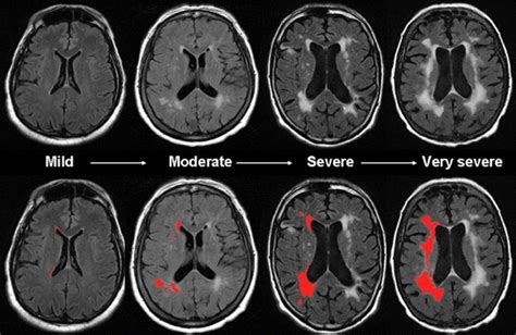 White Matter Disease as a Biomarker for Long-Term Cerebrovascular Disease and Dementia ...