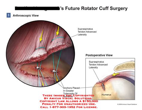 AMICUS Illustration of amicus,surgery,rotator,cuff,tear,supraspinatus,tendon,advanced,laterally ...