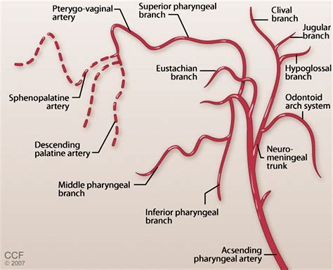 Balloon-augmented Onyx embolization of a dural arteriovenous fistula arising from the ...