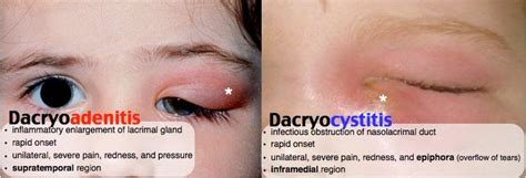 dacryoadenitis vs. dacryocystitis | Eye health, Eyes problems, Eye care