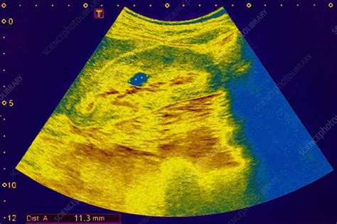 Kidney cyst, ultrasound - Stock Image - C026/8797 - Science Photo Library