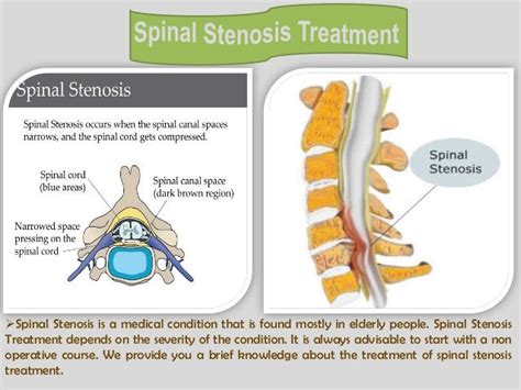 Lumbar spinal stenosis surgery