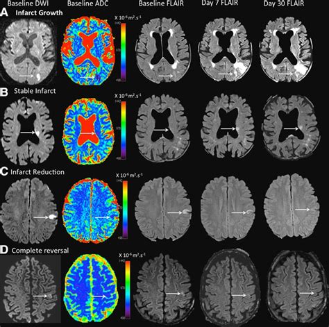 Dynamic Evolution of Diffusion-Weighted Imaging Lesions in Patients With Minor Ischemic Stroke ...