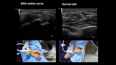 Ultrasoundguided Injection Technique For Ulnar Tunnel