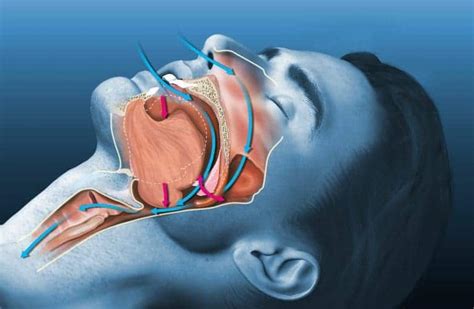 12 Dry Throat Causes And 9 Remedies To Relieve It