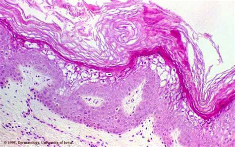 Epidermolytic Hyperkeratosis =انحلال البشرة مفرط التقرن