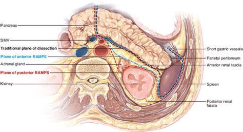 Distal Pancreatectomy & Splenectomy Surgery Cape Town | Hepato-Pancreato-Biliary Procedure