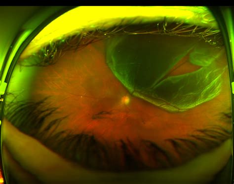 What The Fundus? New Website for Sharing Optos Retinal Images - Eyedolatry