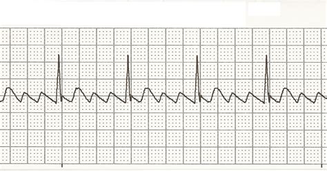 EKG Rhythm Strips 27: Atrial Rhythms
