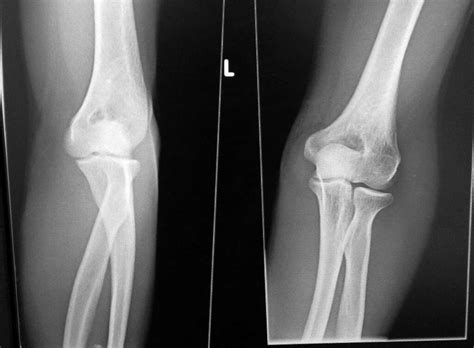 Golfer's Elbow: Golfer's Elbow Symptoms, Treatments and More