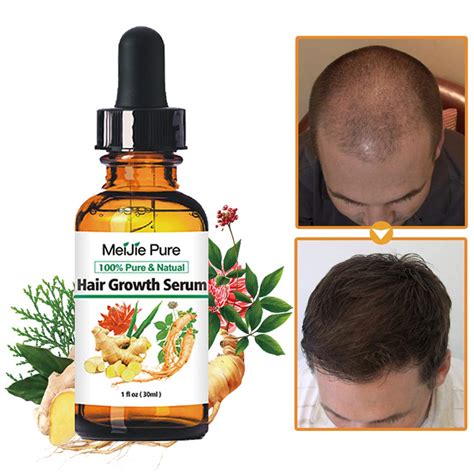 Best Hair Loss Vitamin D - Your Best Life