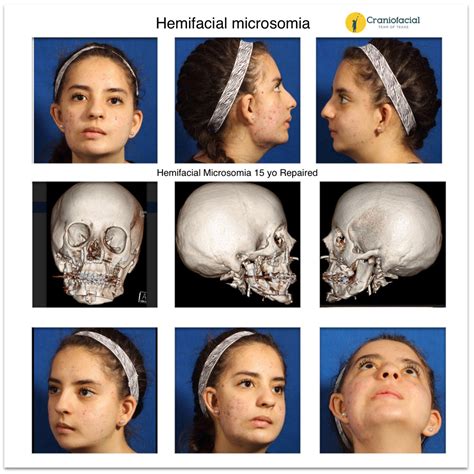 Hemifacial Microsomia Gallery - Dell Children's Craniofacial Team of Texas