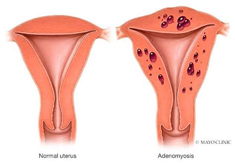 Adenomyosis - Symptoms & causes - Mayo Clinic