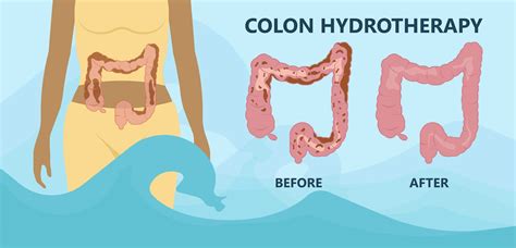 Does Colon Hydrotherapy Work? Behind the Risks vs. Benefits