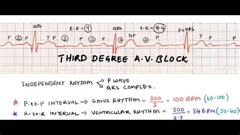Third degree heart block/ complete A V block/ ECG interpretation of complete heart block - YouTube