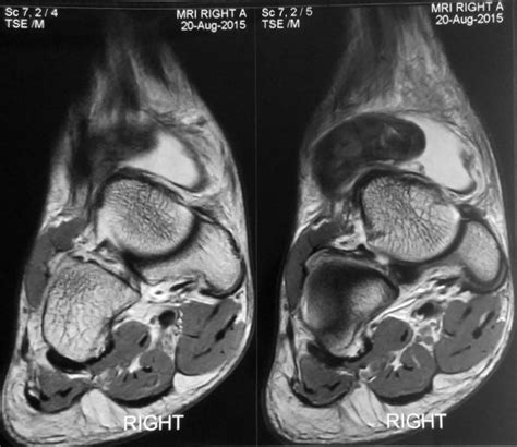 PVNS of the Ankle | Sudden Acute Ankle Pain | HC Chang Orthopaedic ...