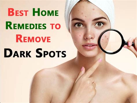 Best Home Remedies To Remove Dark Spots - Boldsky.com