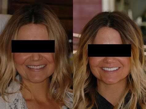 Smile Gallery Before and After Photos | Dr. Steven T. Cutbirth Waco ...