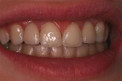 Before and After Dental Bridges Photos