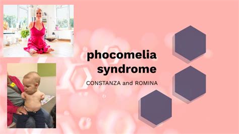 Phocomelia by cons c on Prezi