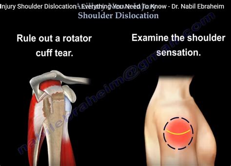 Axillary Nerve Injury in Shoulder Dislocation — OrthopaedicPrinciples.com