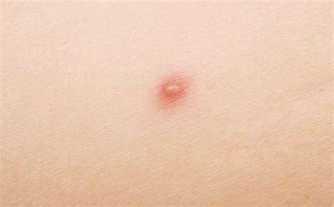 Heat Rash: 10 Heat Rash Symptoms