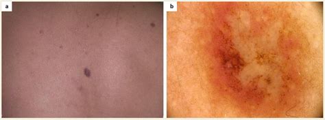 (a) A patient diagnosed with maculopapular cutaneous mastocytosis (MCM)... | Download Scientific ...