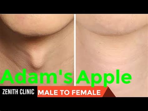 male to female Adam's apple surgery in India|Adam's Apple surgery|mtf| MtF Tracheal shave ...