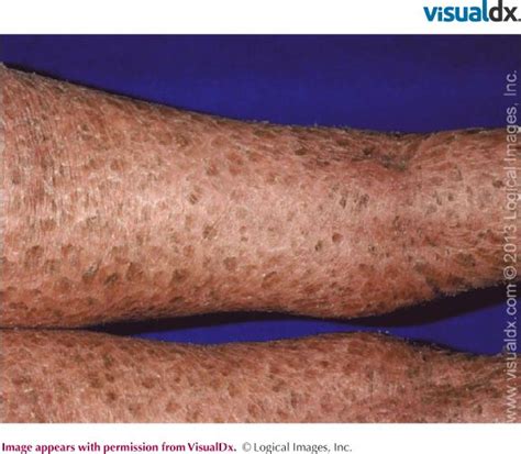 #Lamellar Ichthyosis. (Credit: VisualDX, Journal of Investigative Dermatology) Nature Publishing ...