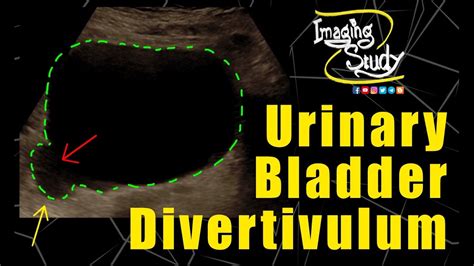 Bladder Diverticulum Ultrasound