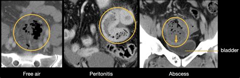 Abdominal CT: diverticulitis • LITFL • Radiology Library