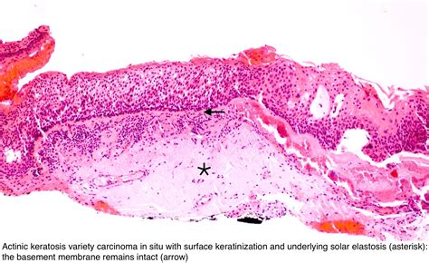 Pathology Outlines - Conjunctiva: conjunctival intraepithelial neoplasia