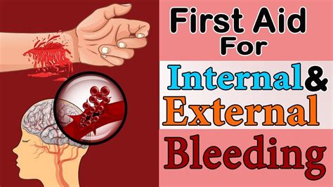 First Aid for External & Internal Bleeding | Great Wall Corporate Services - YouTube