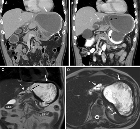 A 65-year-old male with exophytic left hepatic hydatid cyst compressing ...