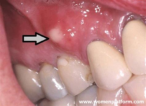 What Causes Tooth Decay? What to do to Treat Gum Swelling? | Women Platform