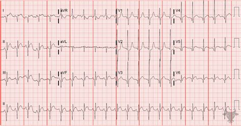 Dextrocardia | ECG Stampede