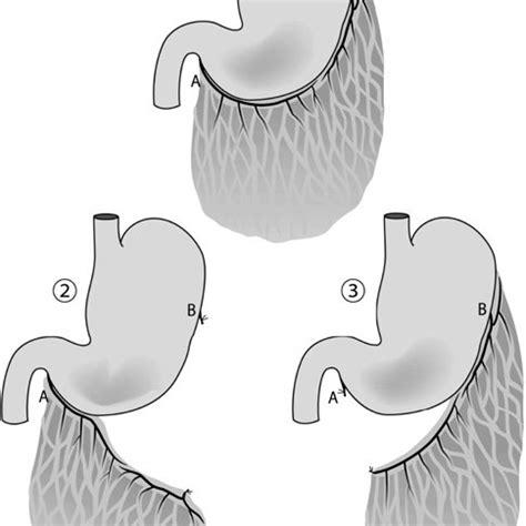 (PDF) The Pedicled Omental Flap Technique for Treating Extensive Defects or Soft-Tissue ...