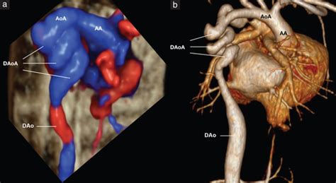 Fetal descending aortic tortuosity with ductal aneurysm - Karmegaraj ...