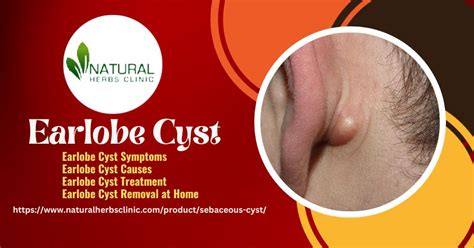 Simple Steps to Earlobe Cyst Removal at Home without Doctor Need