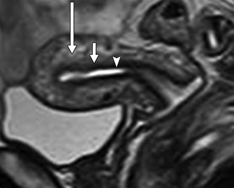 Uterus Anatomy Mri