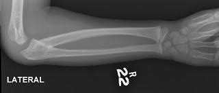 Radius Ulna Synostosis / Congenital Radial Ulnar Synostosis - Max ...