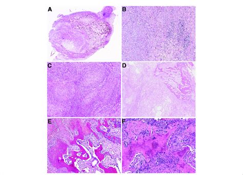 Histopathologic characteristics of myositis ossificans and ...