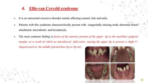 FRENAL ATTACHMENT & ITS MANAGEMENT | PPT