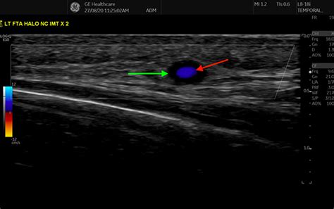 Frontiers | Evolution of ultrasound in giant cell arteritis