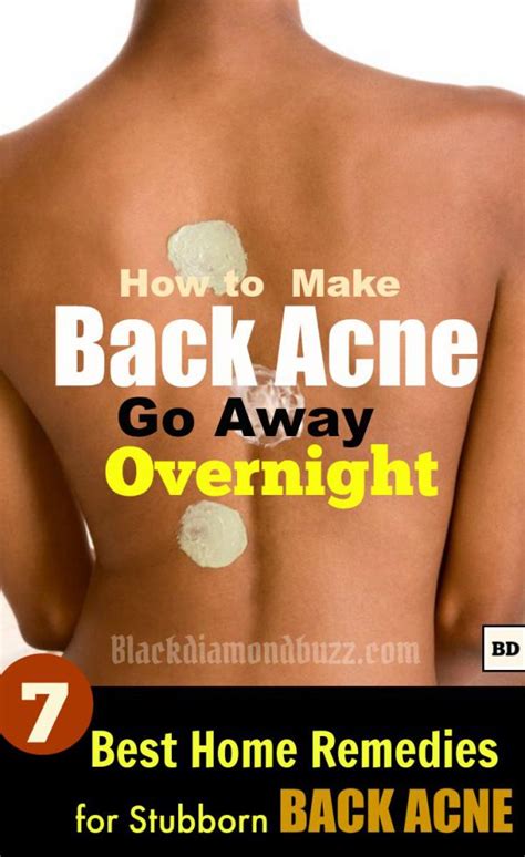 How to Get Rid of Back Acne Fast – 7 Best Home Remedies for Backne - BLACKDIAMONDBUZZ