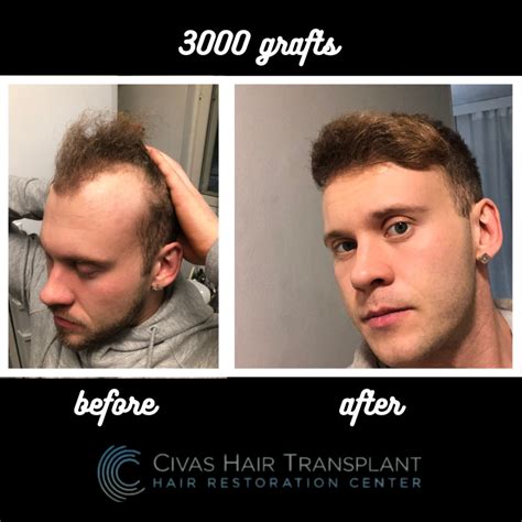 Civas Hair Transplant, 3000 graft, FUE | Hair loss Forum - Hair Transplant forums