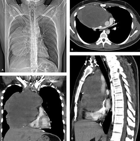 5 Mixed malignant germ cell tumor in a 34-year-old male. Huge anterior... | Download Scientific ...